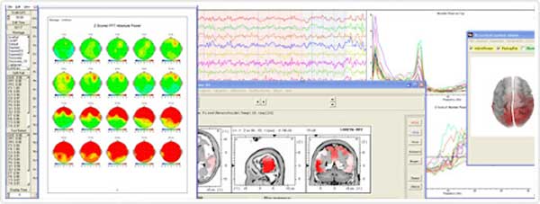 تفاوت نوار مغز با نقشه مغز چیست&hellip;