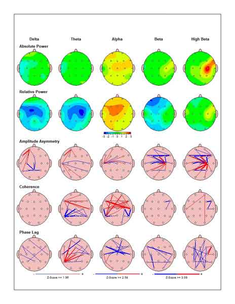 نقشه برداری رنگی مغز یا QEEG چیست&hellip;